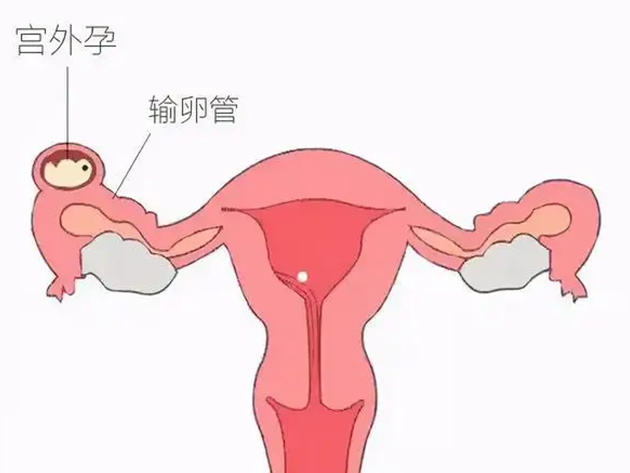 第三代试管婴儿是什么意思