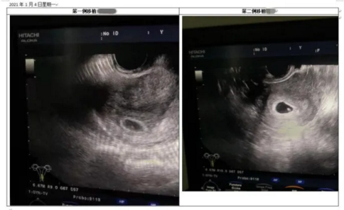 “好孕”来！南医大顺德医院首批“试管婴儿”移植顺利