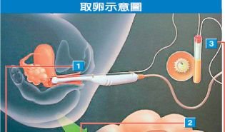 试管婴儿卵泡取出,卵泡取出