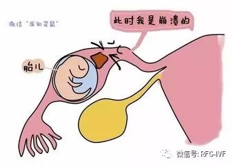 试管婴儿宫外孕,试管婴儿