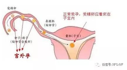 试管婴儿宫外孕,试管婴儿