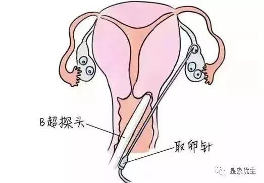 泰国试管婴儿过程疼不疼