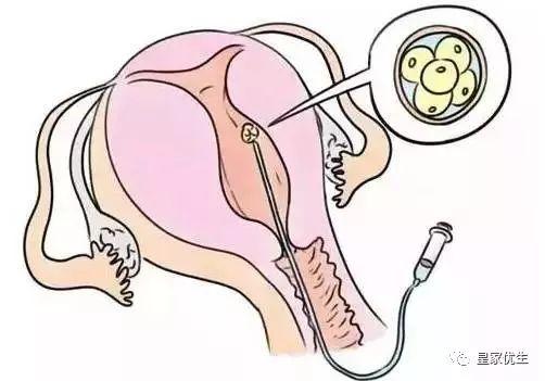泰国试管婴儿过程疼不疼