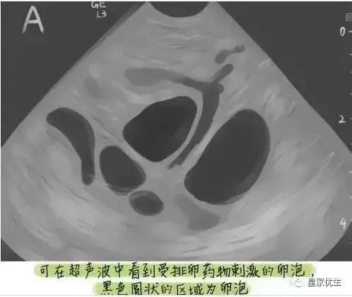 泰国试管婴儿过程疼不疼