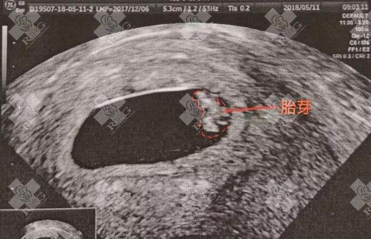 四级胚胎移植成功，但宝宝的健康可以保证吗？