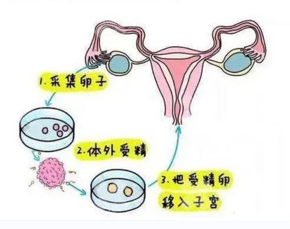 体外受精的优缺点分别是什么？