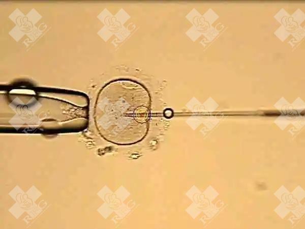 哪些症状可能是长了巧克力囊肿？试管治疗能怀吗？