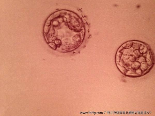 广州三代试管婴儿费用大概是多少？
