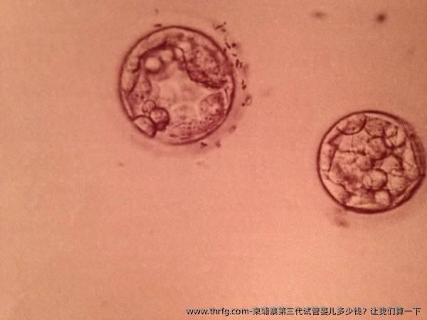 柬埔寨第三代试管婴儿多少钱？让我们算一下