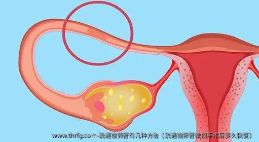 疏通输卵管有几种方法（疏通输卵管微创手术后多久恢复）