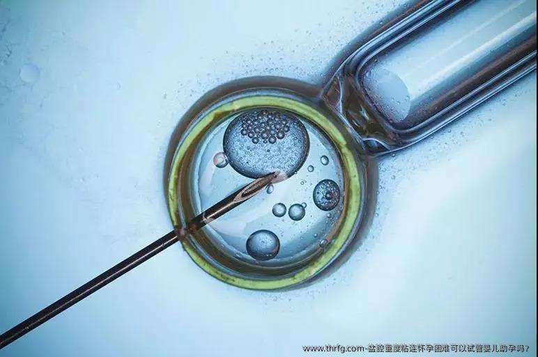 盆腔重度粘连怀孕困难可以试管婴儿助孕吗？