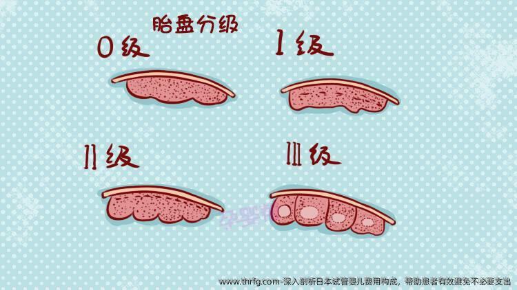 深入剖析日本试管婴儿费用构成，帮助患者有效避免不必要支出