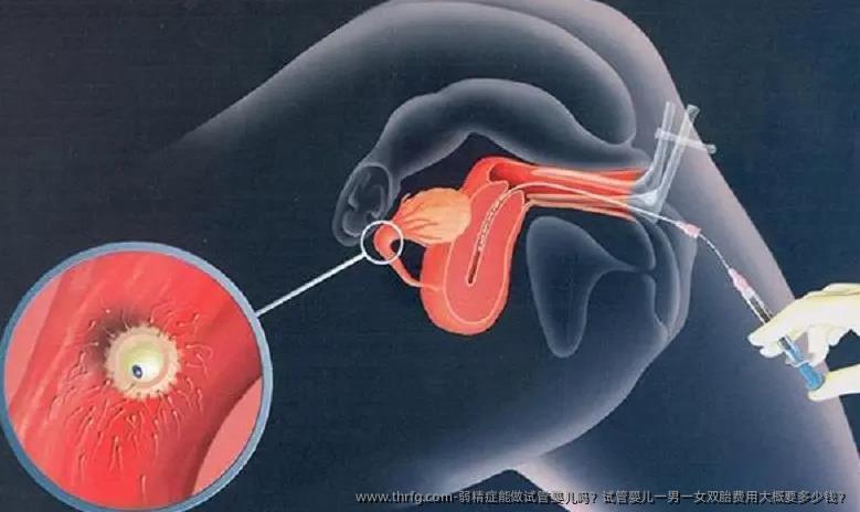 弱精症能做试管婴儿吗？试管婴儿费用大概要多少钱？