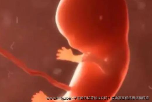 子宫畸形试管能成功吗？成功率高低得看病情程度