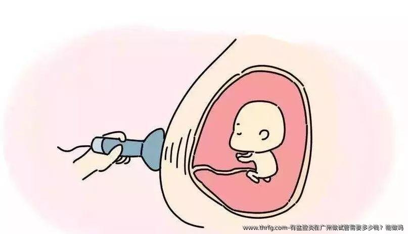 有盆腔炎在广州做试管需要多少钱？能做吗