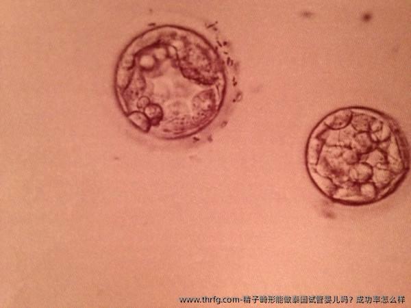 精子畸形能做泰国试管婴儿吗？成功率怎么样