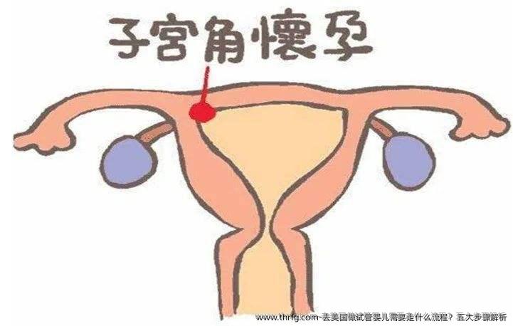 去美国做试管婴儿需要走什么流程？五大步骤解析