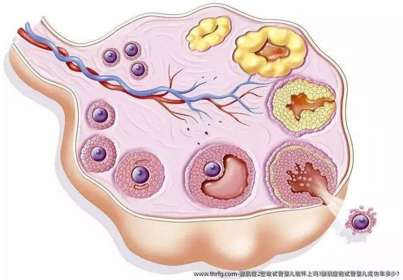 腺肌症2型做试管婴儿能怀上吗?腺肌症能试管婴儿成功率多少?