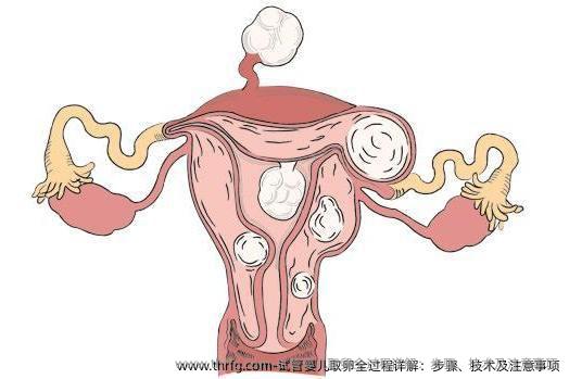 试管婴儿卵泡取出全过程详解：步骤、技术及注意事项