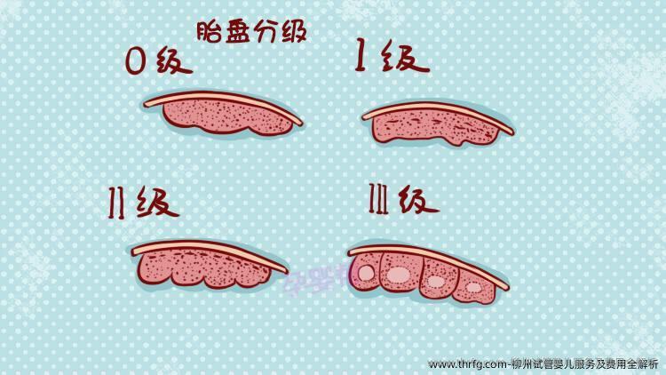 柳州试管婴儿服务及费用全解析