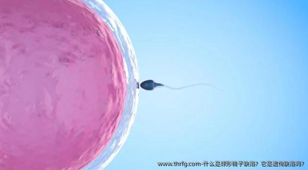 什么是球形精子缺陷？它是遗传缺陷吗?