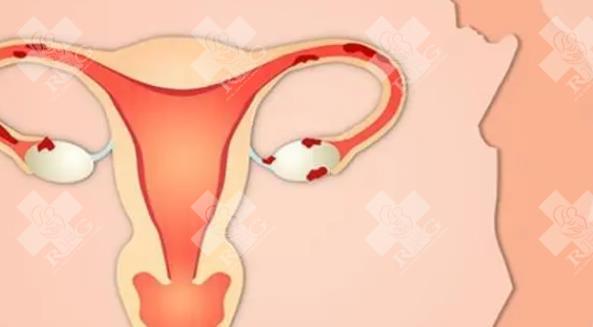 子宫内膜异位症患者应该避免哪些食物？
